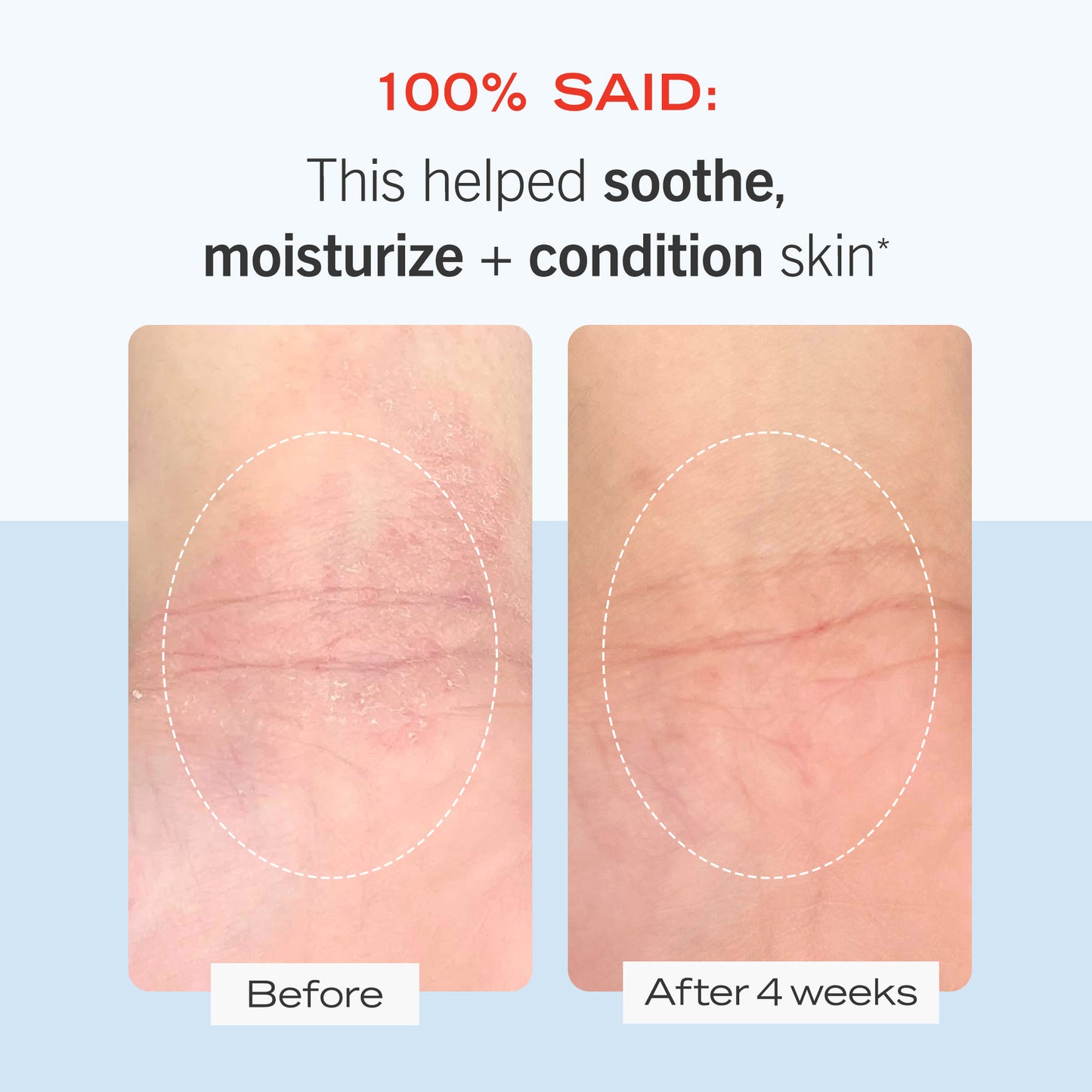 Skin Before and After 4 weeks of using Ultra Repair Cream. 100% said: This helped soothe, moisture + condition skin.