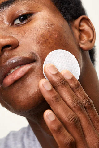 Hormonal Acne: Causes, Treatment & Prevention