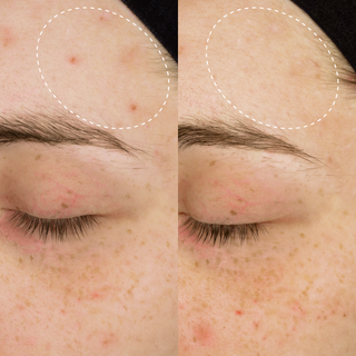 How to Treat Body Acne