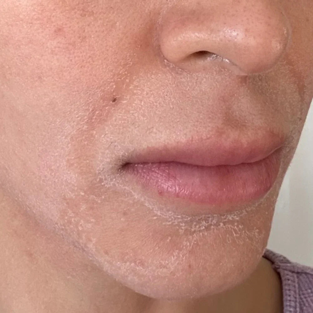 Can Oily Skin Be Dehydrated?