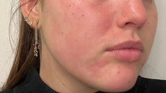 What makes skin sensitive 