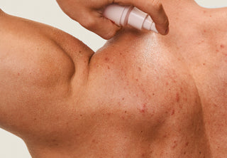 Does Sugar Cause Acne? The Link Between Diet & Skin