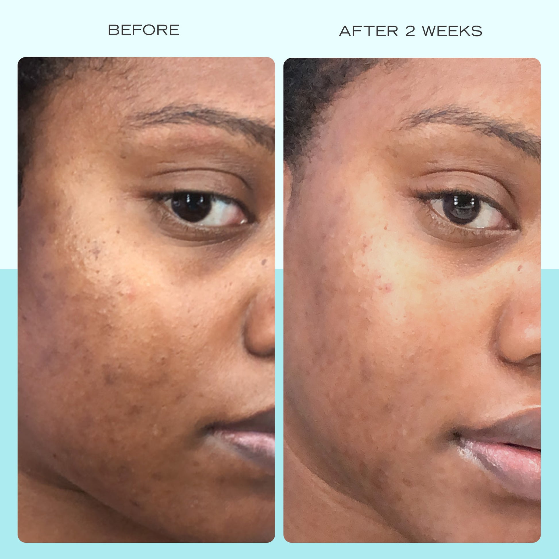 Dark Spot Serum with Niacinamide – First Aid Beauty