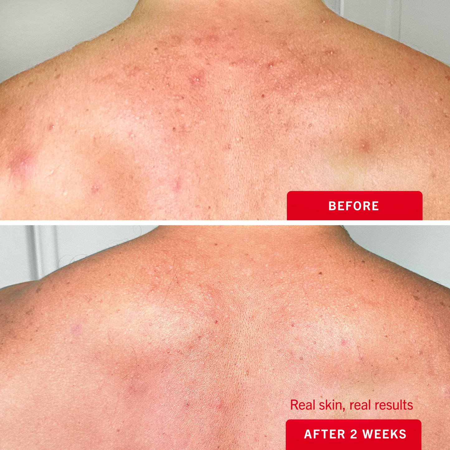 Body Acne Clearing Mist 2% Salicylic Acid