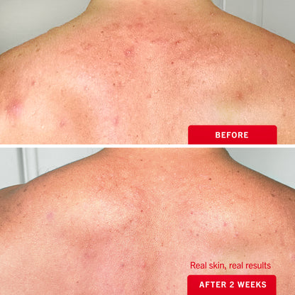 Body Acne Clearing Mist 2% Salicylic Acid