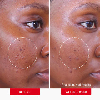 Ultimate Acne Solutions Routine