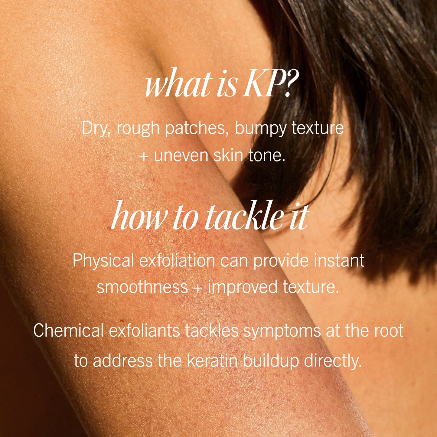 A close-up of a person's arm with text overlay. It reads: "what is KP? Dry, rough patches, bumpy texture + uneven skin tone. how to tackle it Physical exfoliation can provide instant smoothness + improved texture. Chemical exfoliants tackle symptoms at the root to address the keratin buildup directly."
