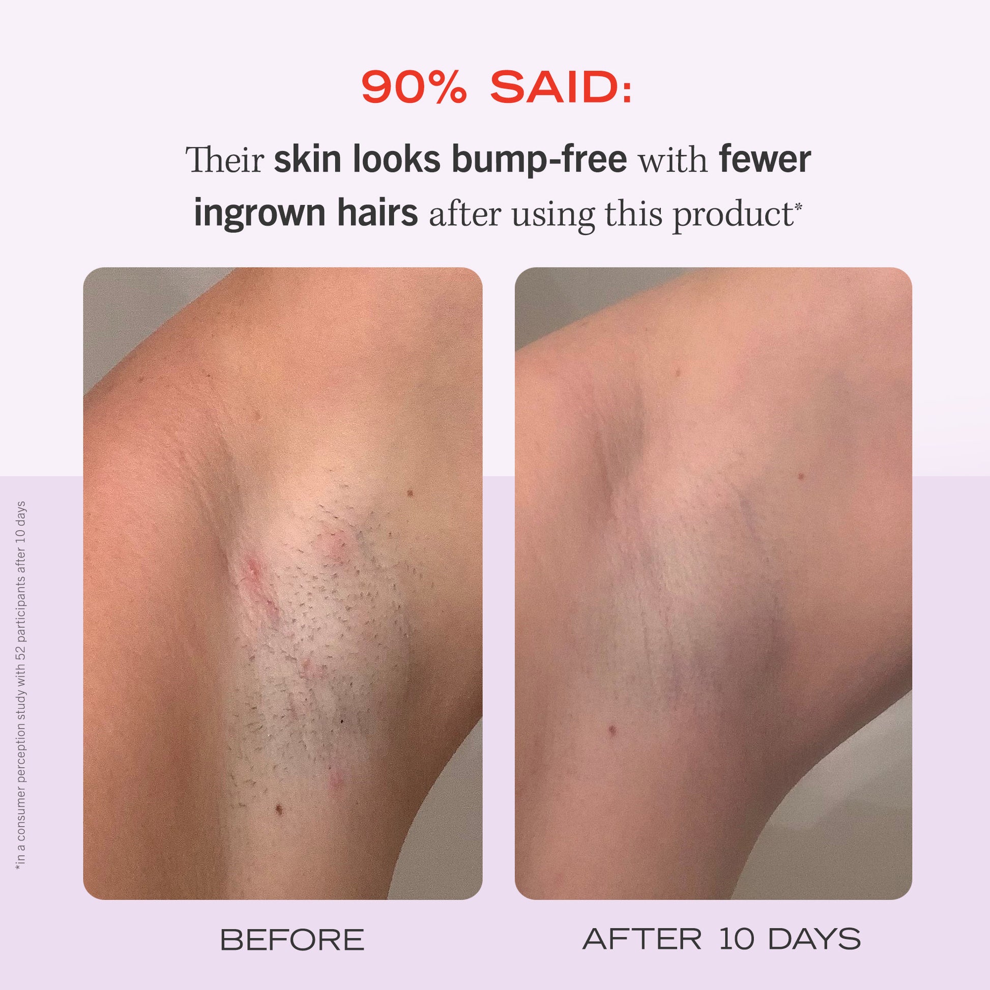 salicylic acid exfoliant before and after ingrown hair