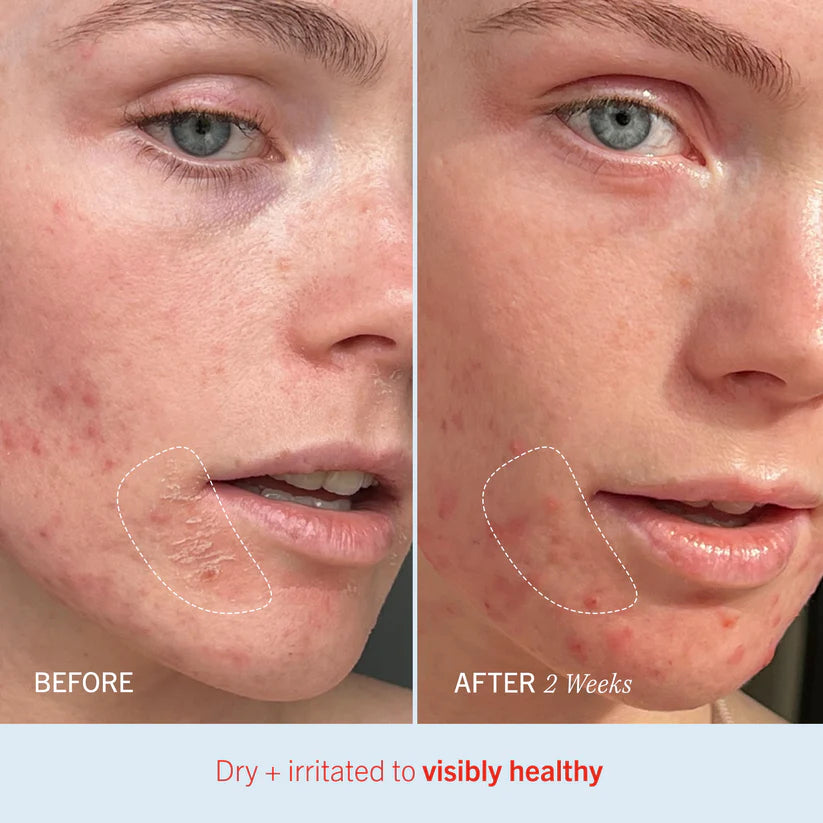 Close-up comparison of a person's cheek showing skin improvement over two weeks. "BEFORE" shows dry, irritated skin, and "AFTER 2 Weeks" shows healthier skin. Text reads: "Dry + irritated to visibly healthy."