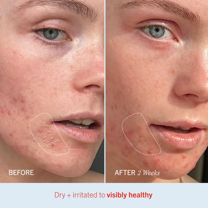Close-up comparison of a person's cheek showing skin improvement over two weeks. "BEFORE" shows dry, irritated skin, and "AFTER 2 Weeks" shows healthier skin. Text reads: "Dry + irritated to visibly healthy."