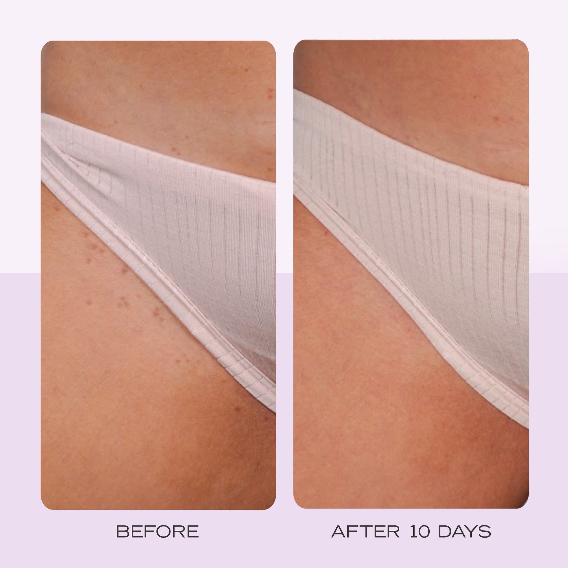 Ingrown Hair Pads with BHA + AHA – First Aid Beauty