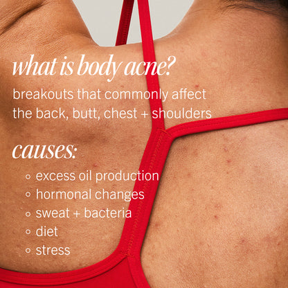 Body Acne Clearing Mist 2% Salicylic Acid