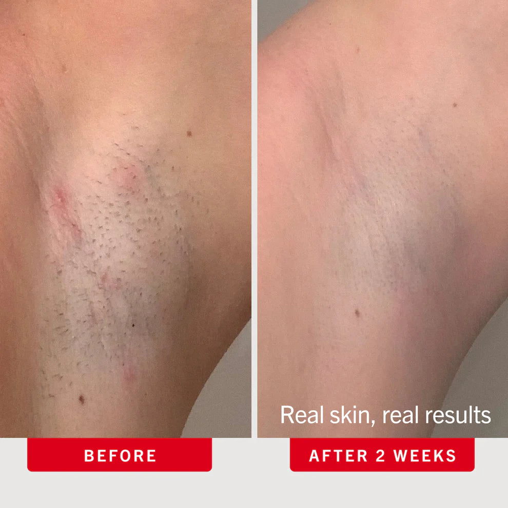 Ingrown Hair Pads with BHA + AHA 60 count