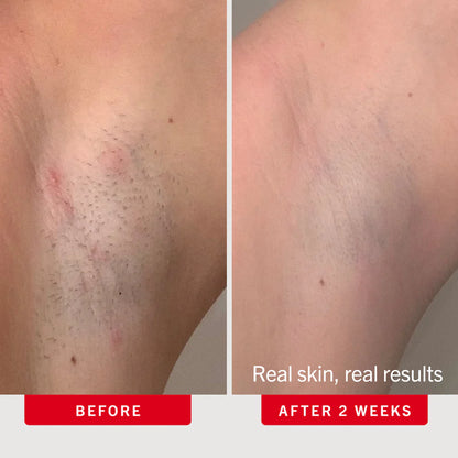 Ingrown Hair Pads with BHA + AHA 60 count