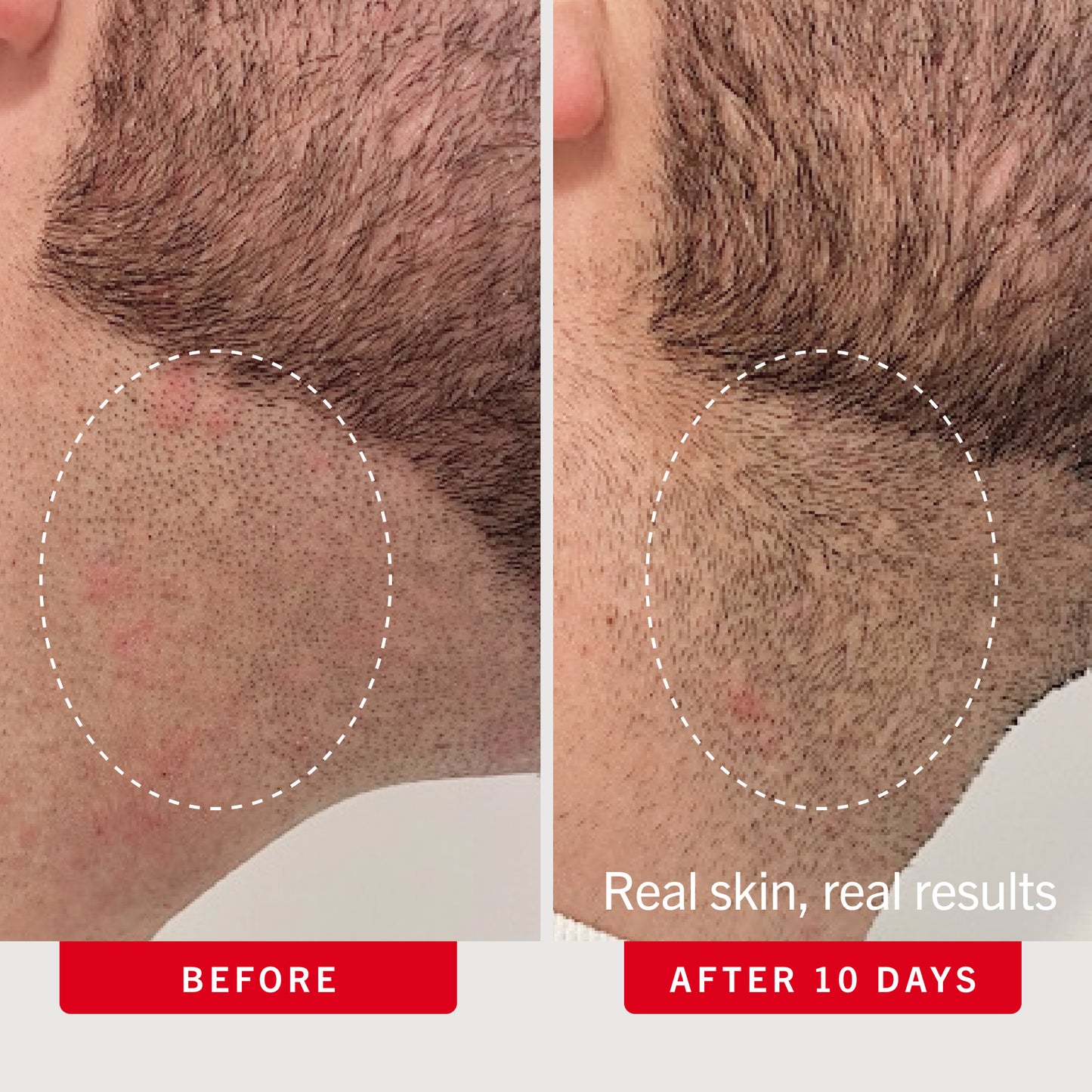 Ingrown Hair Pads with BHA + AHA