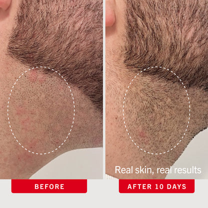 Ingrown Hair Pads with BHA + AHA