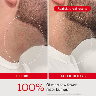 Ingrown Hair Pads Face, Neck + Chest