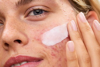 Ultra Repair Rescue Barrier Balm with Dimethicone – First Aid Beauty